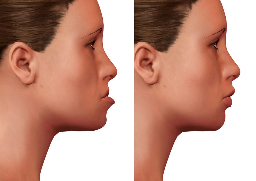 orthognathic surgery, chevy chase md orthodontist for jaw abnormalities